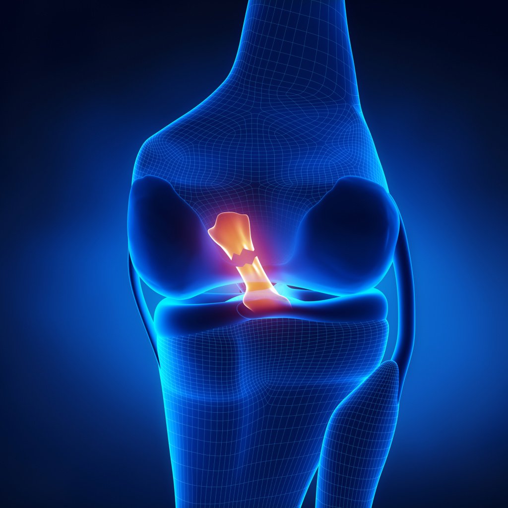 Как происходит разрыв связок коленного сустава